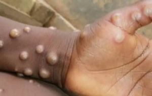 OMS confirma registro de 92 casos de varíola de macaco em 12 países
